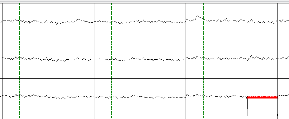 1. Single Electrode Tap